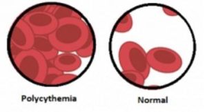 PV Vs Normal Blood Cells Peripheral Smear
