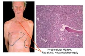 Polycythemia Vera Symptoms signs Clinical Features