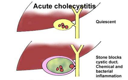 cholecystitis diet