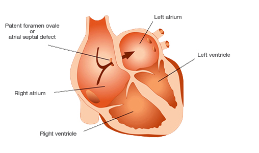 Patent Foramen Ovale (PFO)