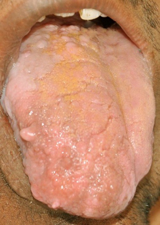 Enlarged Papillae Causes