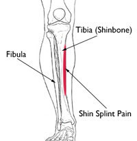 Shin Splints causes
