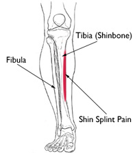 Shin Splints Causes