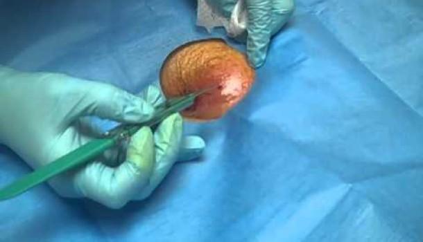 Removal of the cyst through surgery