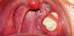 Tonsil Stones Picture 1