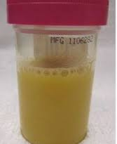 Specimen of cloudy urine