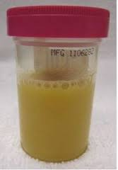 A specimen of cloudy urine