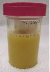 Specimen of cloudy urine