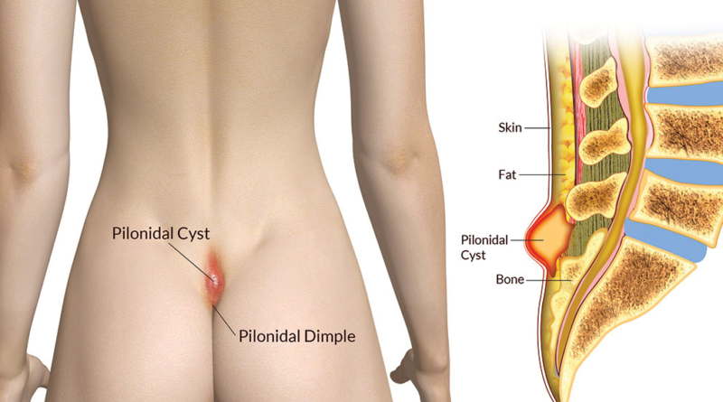 Pilonidal cyst location images