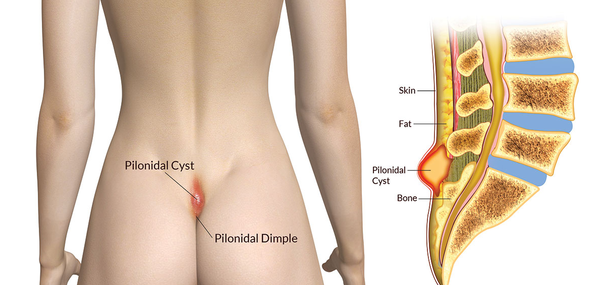 The Pilonidal Cyst or Cyst of the tailbone