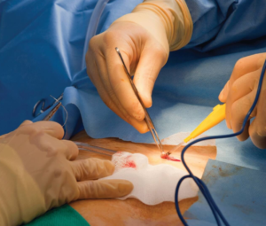 Pilonidal Cyst Surgery