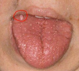 Enlarged Papillae Picture