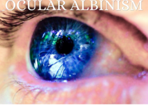 Ocular Albinism Picture