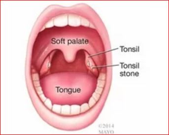 Tonsil Stones Types
