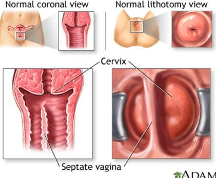 Nőhet a vestibularis papillomatosis