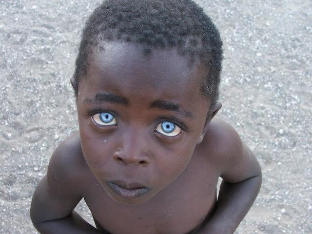 African blue-eyed boy with ocular albinism