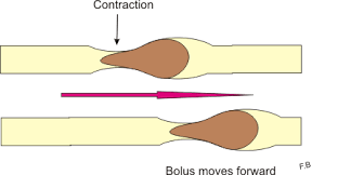 Hyperactive Bowel Sounds