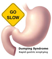 Dumping Syndrome And Rapid Gastric Emptying