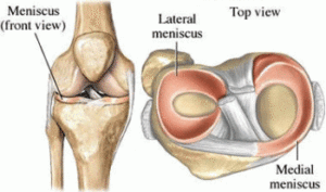 Image result for medial meniscus