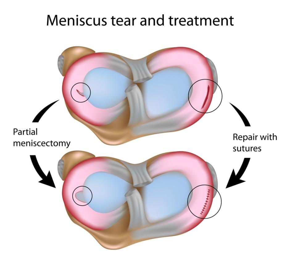 Can A Knee Meniscus Tear Heal On Its Own