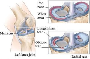 Image result for medial meniscus tear