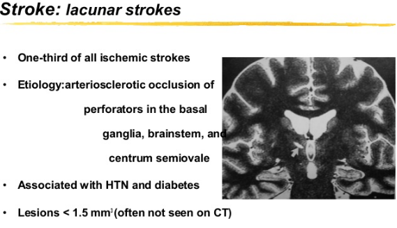 Centrum Semiovale Stroke