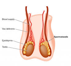 Spermatocele Picture 1