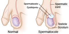 Spermatocele Location