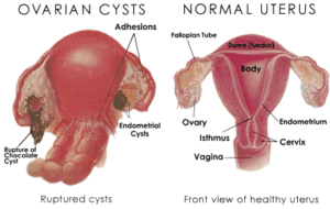 ovary with a cyst