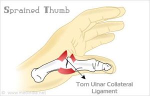 sprained thumb