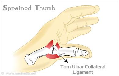 Sprained Thumb