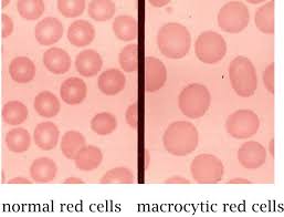 Macrocytic Anemia Types Of Blood Cells