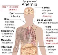 symptoms of anemia