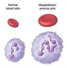 macrocytic anemia cells