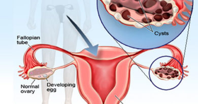 Hemorrhagic Cyst (ovary)