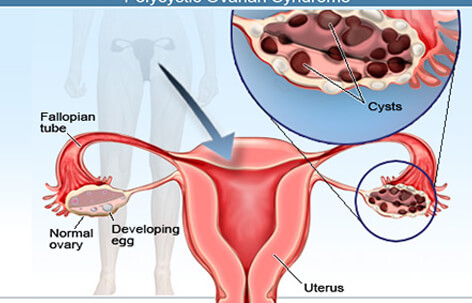 Hemorrhagic Cyst (ovary)