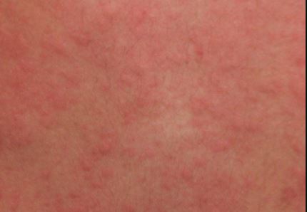 Cholinergic Urticaria images