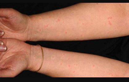 Cholinergic Urticaria pics