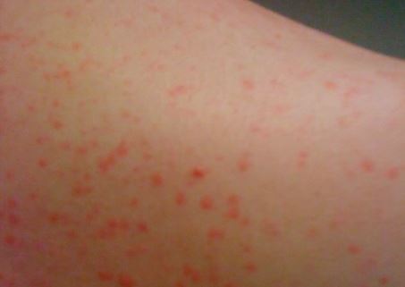 Cholinergic Urticaria pictures