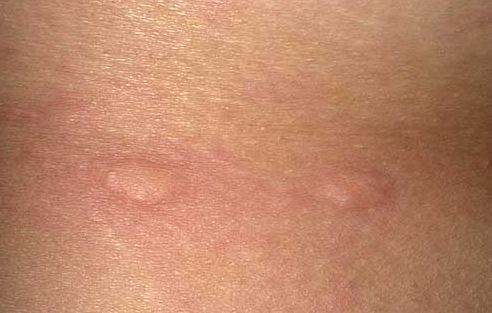 Cholinergic Urticaria