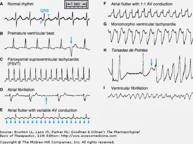 regular irregular heartbeat